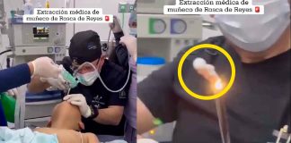#VIDEO | Paciente fue operado de emergencia tras tragarse accidentalmente el muñeco de la rosca de Reyes
