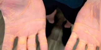 Hombre que solo comió queso, carne de res y mantequilla durante 8 meses llega al hospital con colesterol saliendo de su cuerpo