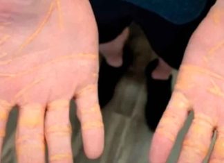 Hombre que solo comió queso, carne de res y mantequilla durante 8 meses llega al hospital con colesterol saliendo de su cuerpo