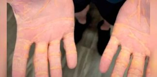 Hombre que solo comió queso, carne y mantequilla sufre raro efecto secundario en su piel: Colesterol sale de su cuerpo