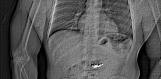 Ladrón se traga aretes de 15 millones de pesos y lo arrestan con los diamantes en el estómago