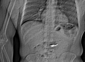 Ladrón se traga aretes de 15 millones de pesos y lo arrestan con los diamantes en el estómago