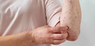 Aumenta a 421 los casos de sarampión en México