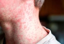 Jalisco enfrenta brote de sarampión; Arandas concentra la mayoría de los casos