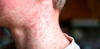 Jalisco enfrenta brote de sarampión; Arandas concentra la mayoría de los casos