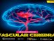 Cómo identificar signos de alarma de una enfermedad vascular cerebral: SSM