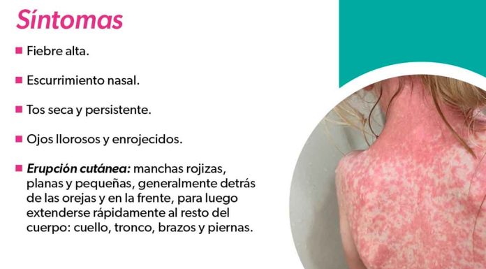 Identifica los síntomas del sarampión y protege tu salud: SSM