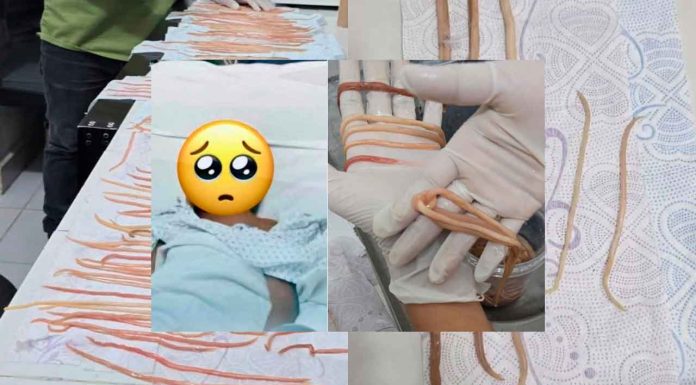 Inusual caso en Chiapas un niño con dolor abdominal es intervenido y le extraen 142 lombrices intestinales