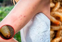 Detectan en EE. UU. el primer caso humano de gusano barrenador en décadas