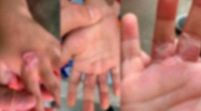 #México: Dos niños son rescatados del novio de su madre; colocaba sus manos en el comal “por no calentar bien las tortillas”