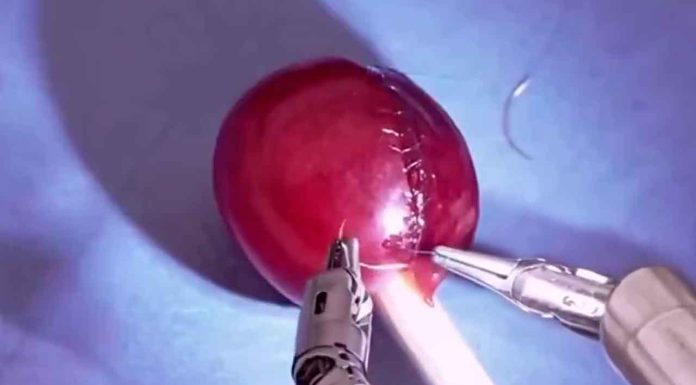 #VIDEO || El asombroso sistema quirúrgico Da Vinci y su precisión milimétrica