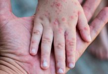 Coxsackie o síndrome mano-pie-boca: lo que debes saber sobre este virus común en niños