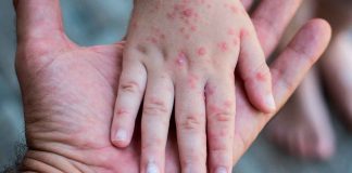 Coxsackie o síndrome mano-pie-boca: lo que debes saber sobre este virus común en niños