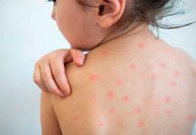 América pierde su estatus libre de sarampión