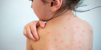 América pierde su estatus libre de sarampión