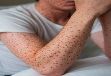 Brotes activos de sarampión en 2026: estados con casos en México y Estados Unidos