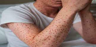 Brotes activos de sarampión en 2026: estados con casos en México y Estados Unidos