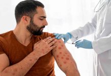 México tiene dos meses para contener el brote de sarampión y conservar estatus sanitario