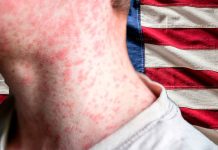 EE. UU. podría perder estatus de país libre de sarampión