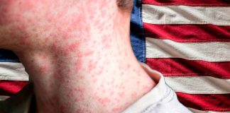 EE. UU. podría perder estatus de país libre de sarampión