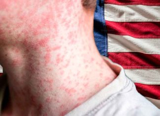 EE. UU. podría perder estatus de país libre de sarampión