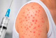 Siete mil casos de sarampión en México, Michoacán de los 7 estados con casos confirmados