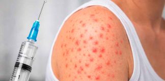 Siete mil casos de sarampión en México, Michoacán de los 7 estados con casos confirmados