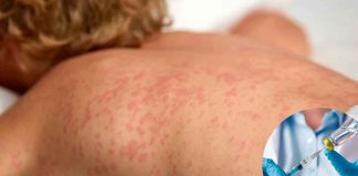 Salud Pública adelanta vacunación contra el sarampión ante incremento de contagios en México