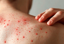 UNAM advierte: Sarampión, más contagioso que COVID-19, registra aumento en invierno