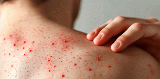 UNAM advierte: Sarampión, más contagioso que COVID-19, registra aumento en invierno