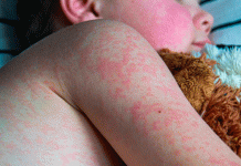 Confirman muerte de menor por complicaciones de sarampión