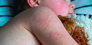 Confirman muerte de menor por complicaciones de sarampión