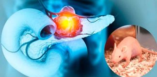 ¡Avance histórico! científicos logran eliminar el cáncer de páncreas en modelos animales