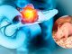 ¡Avance histórico! científicos logran eliminar el cáncer de páncreas en modelos animales