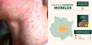Surgen tres casos de sarampión en Tlaltizapán Morelos