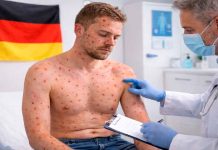 México confirma primer caso de viruela símica en paciente alemán; activan vigilancia epidemiológica