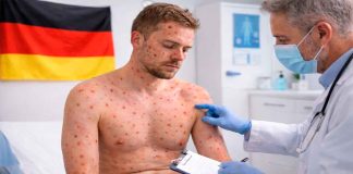 México confirma primer caso de viruela símica en paciente alemán; activan vigilancia epidemiológica