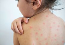 México acumula más de 7 600 casos de sarampión y 26 muertes