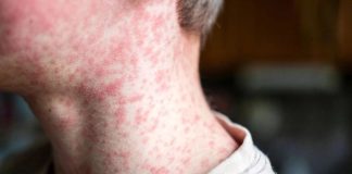 ¿El sarampión podría provocar una nueva pandemia? Esto es lo que realmente preocupa a expertos