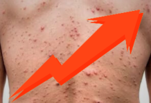 Sarampión en México deja 31 muertos y casi 10 mil contagios confirmados