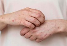 OPS emite alerta epidemiológica por aumento de casos de sarampión en América