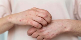 OPS emite alerta epidemiológica por aumento de casos de sarampión en América