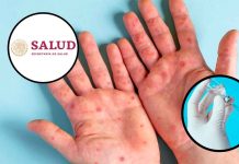 ¿Dónde vacunarse contra el sarampión en Morelia? Estos son los 12 módulos activos de la SSM