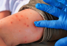 México encabeza los casos de sarampión en América y activa alerta epidemiológica por el aumento de contagios