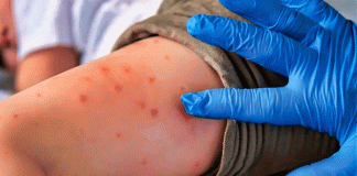 México encabeza los casos de sarampión en América y activa alerta epidemiológica por el aumento de contagios