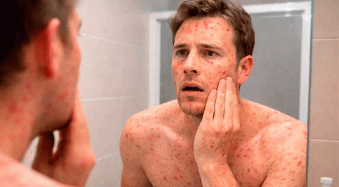 Brote de sarampión en México: qué hacer si hay contagio y cuánto dura la enfermedad