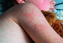 Segunda muerte por sarampión en Durango y brote en aumento