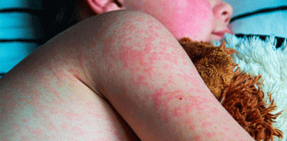 Segunda muerte por sarampión en Durango y brote en aumento