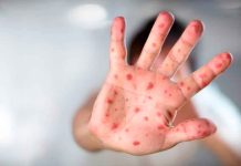 México registra casi 9 mil casos y 28 muertes por brote de sarampión; autoridades intensifican vacunación