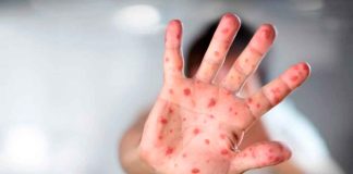 México registra casi 9 mil casos y 28 muertes por brote de sarampión; autoridades intensifican vacunación